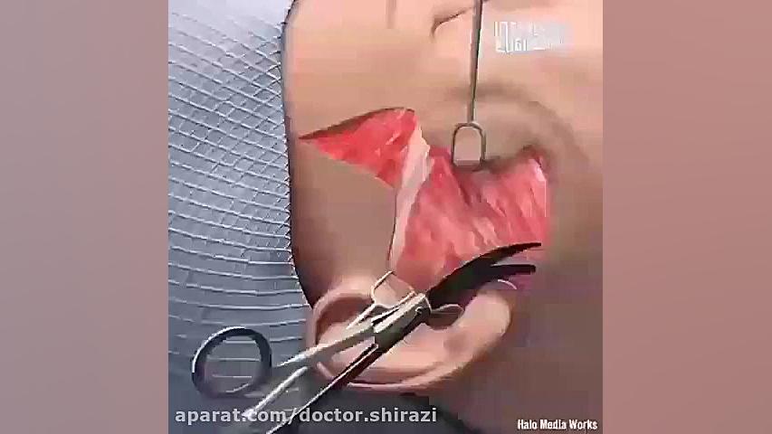 جراحی لیفت صورت پلاستیک لثه