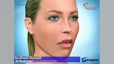 اپن بایت و جراحی فک - دکتر سعید قریشی دکتر سعید قریشی