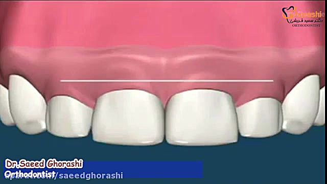 جراحی لثه - دکتر سعید قریشی دکتر سعید قریشی