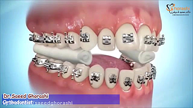 مراحل براکت گذاری در ارتودنسی - دکتر سعید قریشی دکتر سعید قریشی