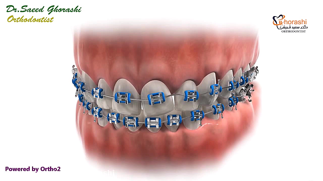 شکستن براکت ها در ارتودنسی - دکتر سعید قریشی دکتر سعید قریشی