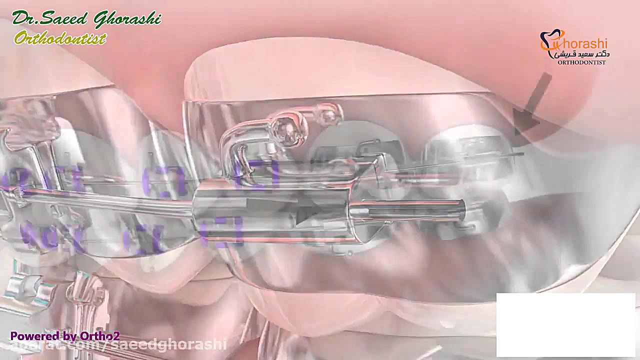 موم ارتودنسی - دکتر سعید قریشی دکتر سعید قریشی