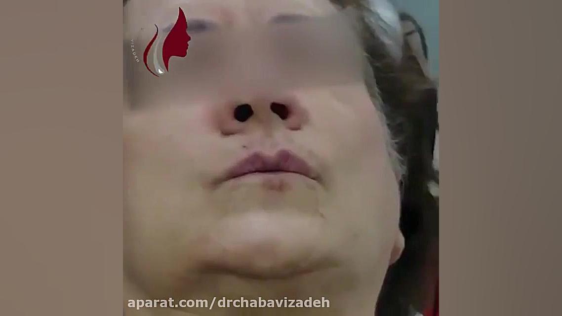 رفع چین و چروک های دورلب با ژل بلاترو دکتر صفیه چعباوی زاده