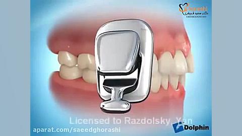 ارتودنسی لینگوال - دکتر سعید قریشی دکتر سعید قریشی