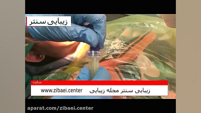 سفید کردن دندان یا بلیچینگ دندان با ژل - دستگاه پیشرفته - زیبایی سنتر پیلینگ شیمیایی