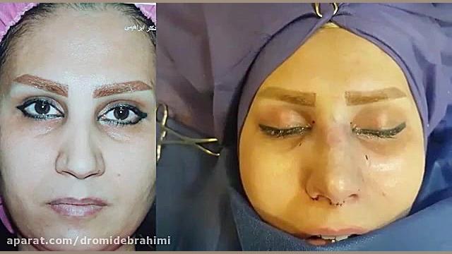 جراحی بینی گوشتی توسط دکتر امید ابراهیمی بهترین جراح بینی گوشتی دکتر امید ابراهیمی