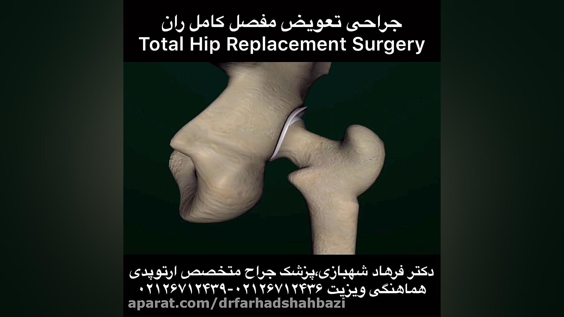 کلیپ پزشکی از عمل جراحی تعویض مفصل لگن،پروتز ران،پزشک جراح متخصص ارتوپدی۲۶۷۱۲۴۳۹ پروتز دندان