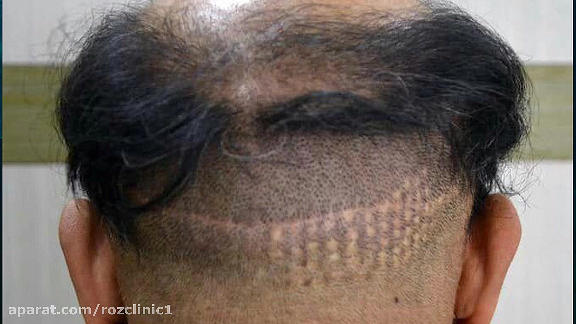 کاشت مو | فیلم کاشت مو | کلینیک پوست و مو رز | شماره25 طب پرواز