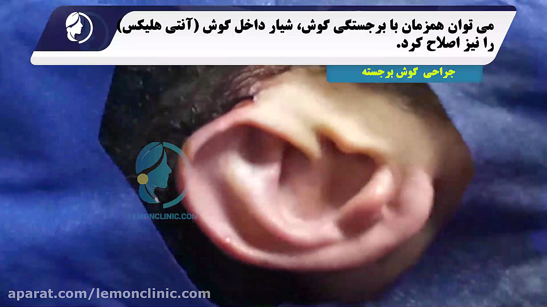 جراحی گوش برجسته کامپوزیت ونیر