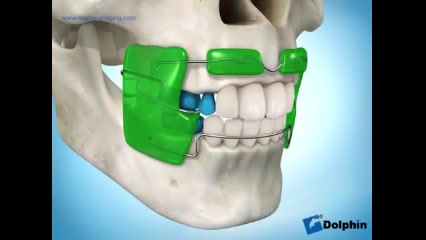 کراس بایت (cross bite) دکتر سهیل سالاری
