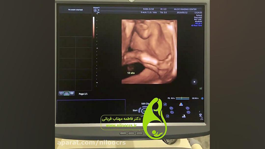جنین و آب بازی سونوگرافی نیلو دکتر فاطمه مهتاب قربانی