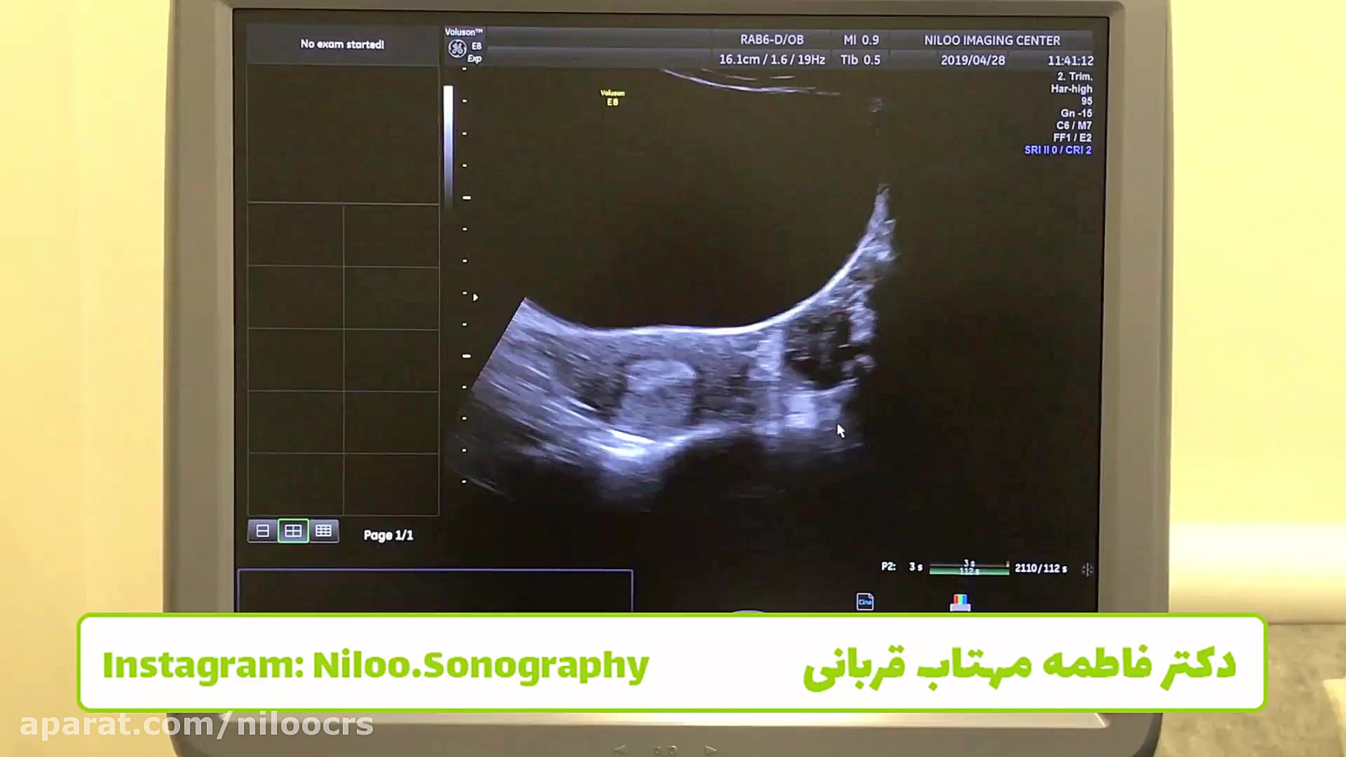 تخمدان پلی کیستیک هایفوتراپی