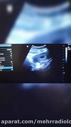 فیلم تشکیل ساک حاملگی