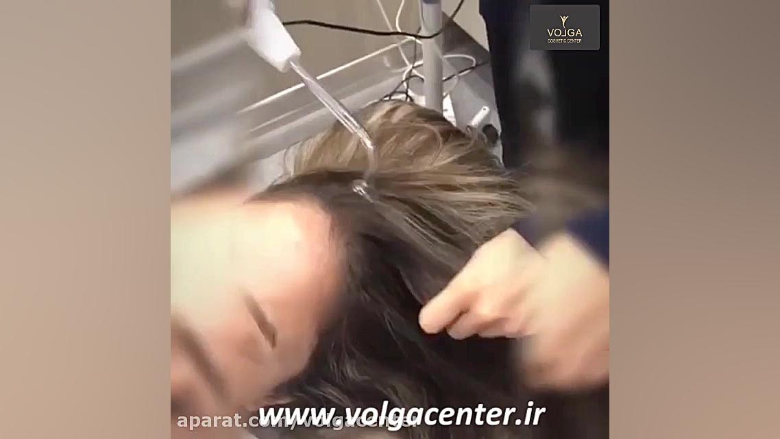 ترمودرمی و ماساژ موی سر قلی قندق