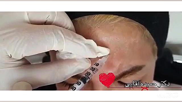 فیلم تزریق بوتاکس به پیشانی MAP