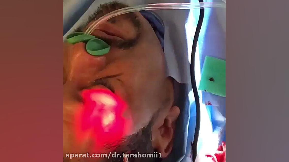 فیلم لیفت پیشانی و ابرو در آقایان ترمیم سوختگی