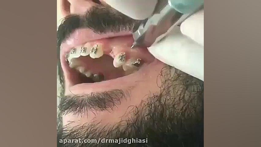 مینی ایمپلنت دندان-دکترمجیدقیاسی دندانپزشک زیبایی مشهد دکترمجیدقیاسی