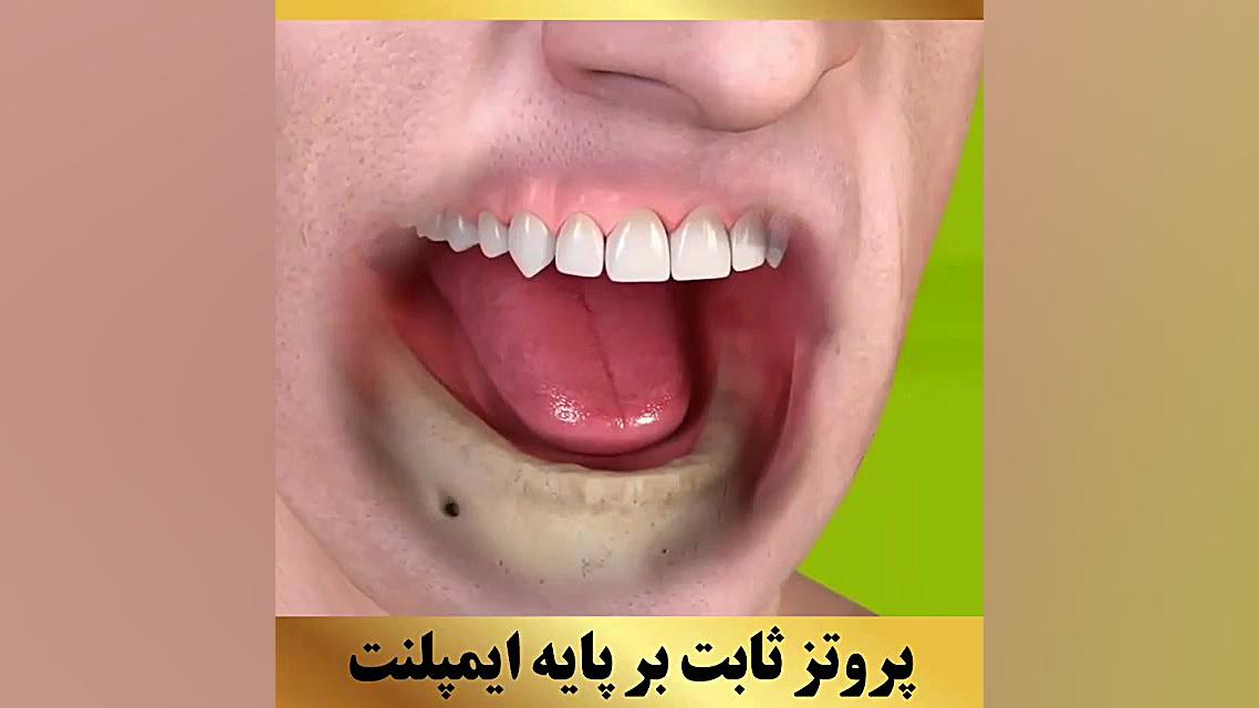 پروتز ثابت بر پایه ی ایمپلنت | کلینیک دندانپزشکی سیمادنت مزوتراپی
