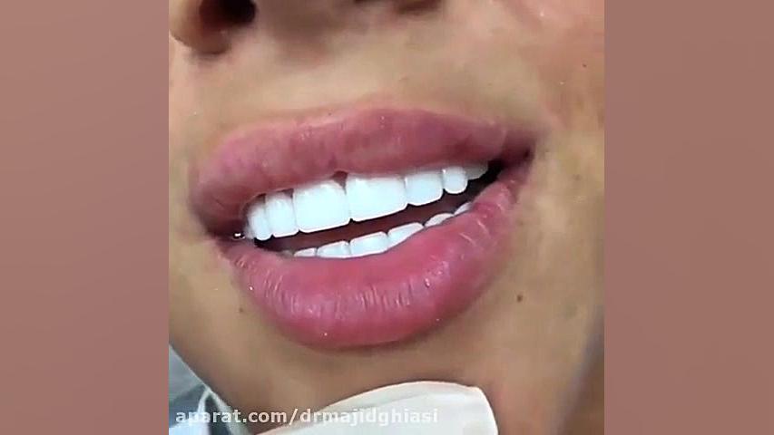 لبخند هالیوودی-دکترمجیدقیاسی دندانپزشک زیبایی مشهد دکترمجیدقیاسی