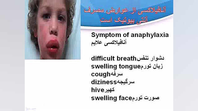 عوارض مصرف بی رویه آنتی بیوتیک زاویه سازی صورت