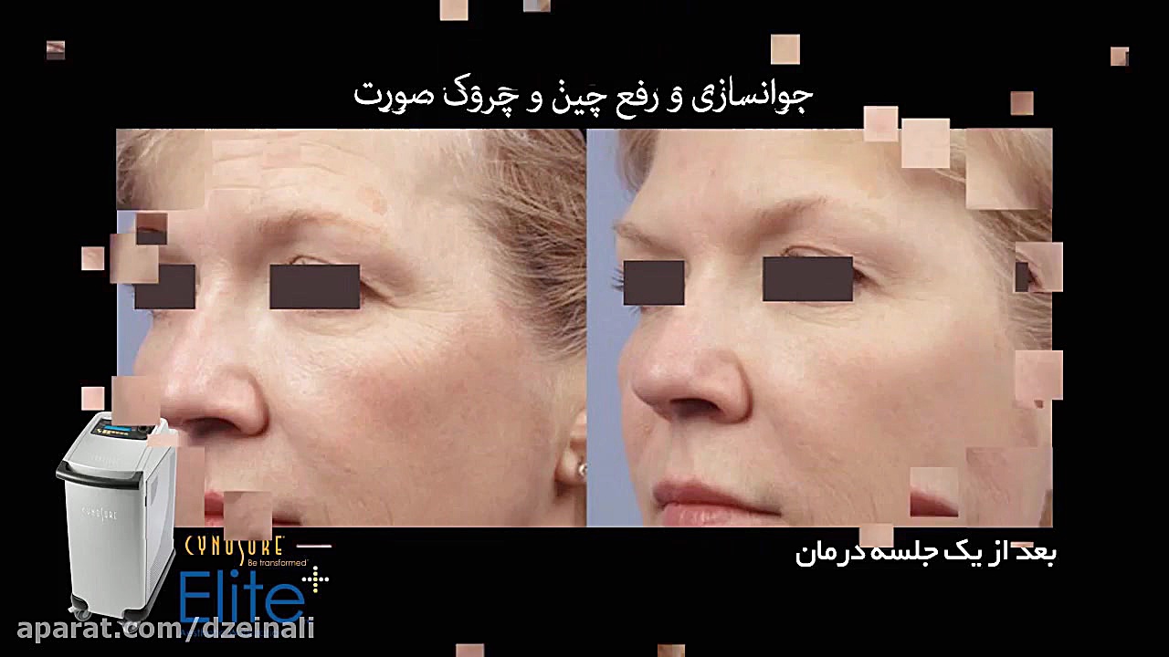 دستگاه لیزر الیت پلاس دکتر فرحناز زینعلی - متخصص پوست، مو، زیبایی زنجان