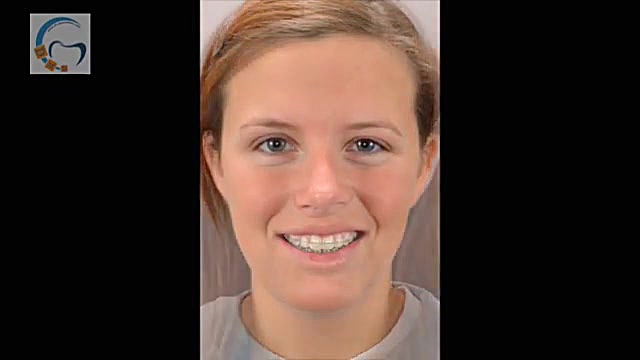 ارتودنسی و جراحی فک لبخند لثه ای | دکتر داوودیان کاپوت سکودانئوم