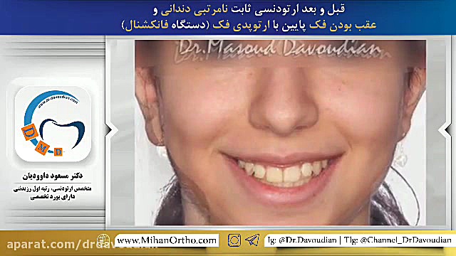 ارتودنسی ثابت به همراه دستگاه فانکشنال | دکتر داوودیان پیلینگ شیمیایی