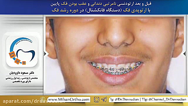 دستگاه فانکشنال ارتودنسی | دکتر داوودیان پست اردکی