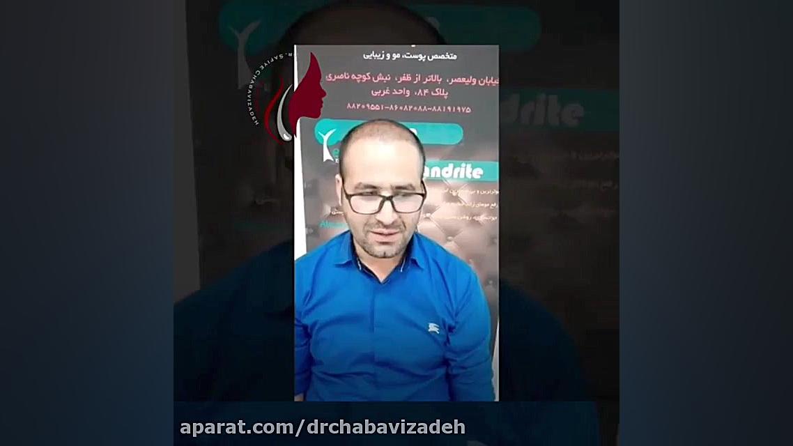 کاشت مو با تراکم بالا( زیاد)ورضایتمندی مراجعه کننده دکتر صفیه چعباوی زاده