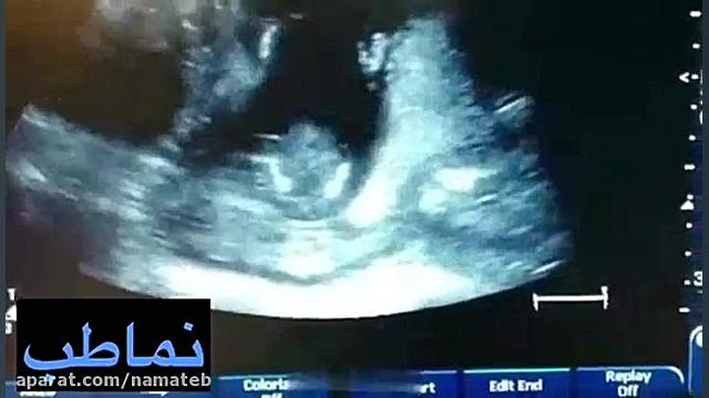 سونوگرافی جنین | مرکز تصویربرداری پزشکی نماطب آهنگ بترکون
