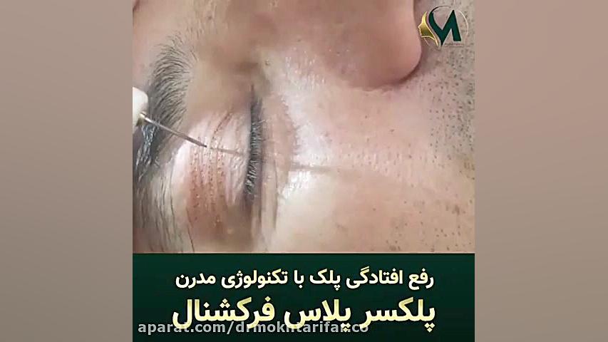 پلکسر پلاس فرکشنال فراتر از یک ابزار دکتر فاطمه مختاری فر جراح بینی در لرستان