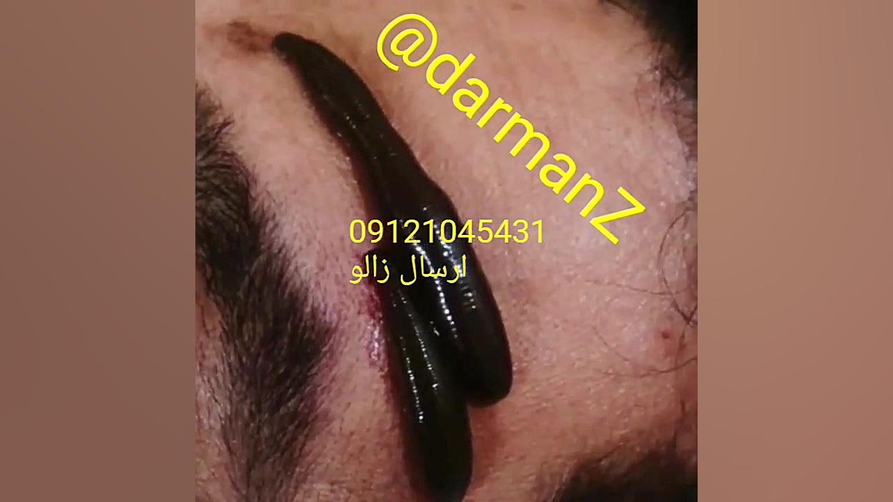 زالو درمانی میگرن ارتودنسی