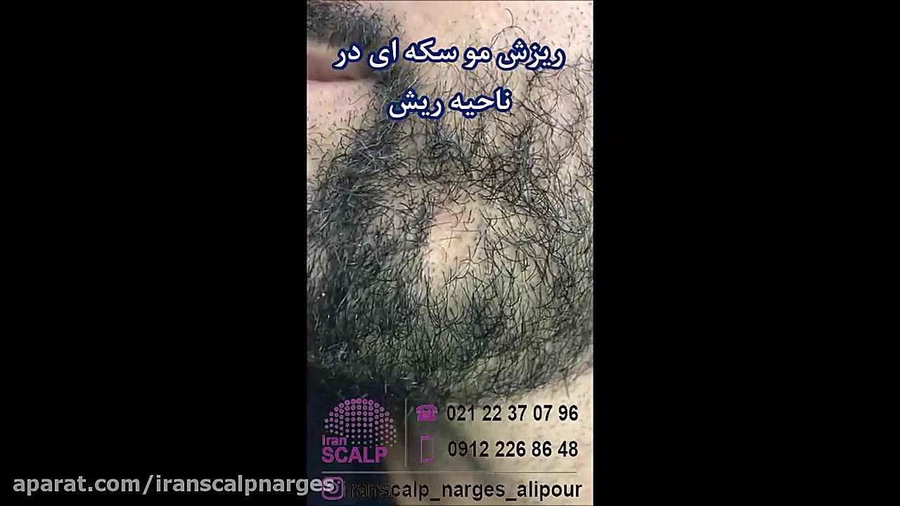 درمان ریزش مو سکه ای ریش اسکالپ سر خانم نرگس علیپور بیماری اپیدرمولیز بولوزا