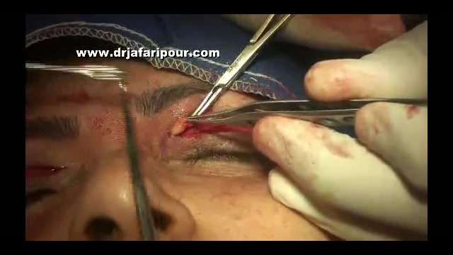 جراحی زیبایی پلک دکتر مسعود جعفری پور