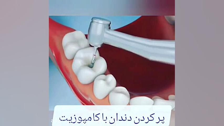 فیلم پرکردن دندان با کامپوزیت جراحی فک