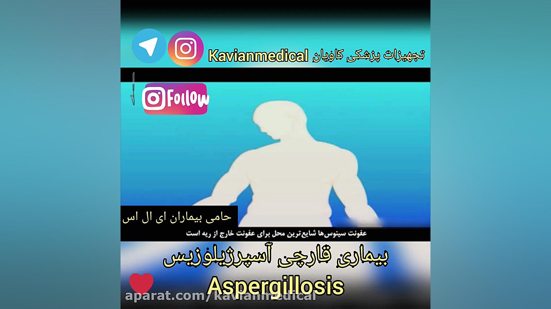 بیماری قارچی آسپرژیلوزیس کیهان کلهر