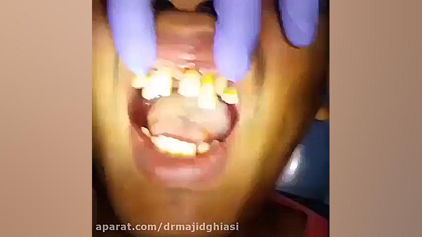 عفونت لثه -دکترمجیدقیاسی دندانپزشک زیبایی مشهد دکترمجیدقیاسی
