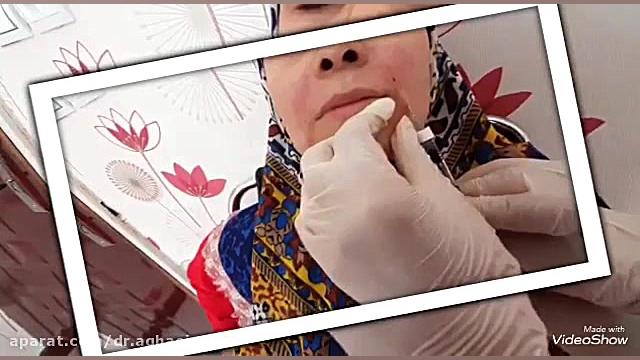 فیلم تزریق ژل خط خنده دکتر حمیده آقایی