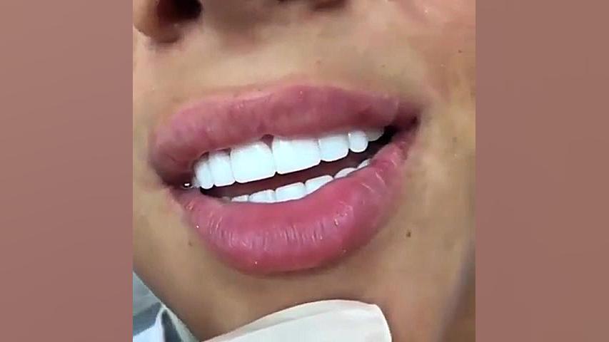 اصلاح طرح لبخند-دکترمجیدقیاسی دندانپزشک زیبایی مشهد سیستم نانواینژکتور