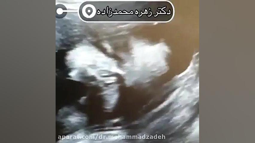 سونوگرافی سر و صورت جنین را از دست ندهید استریمر