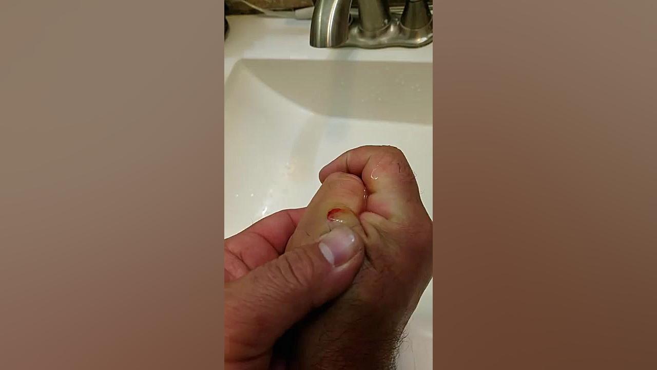خارج كردن چرك و عفونت زير پوست عصب‌کشی