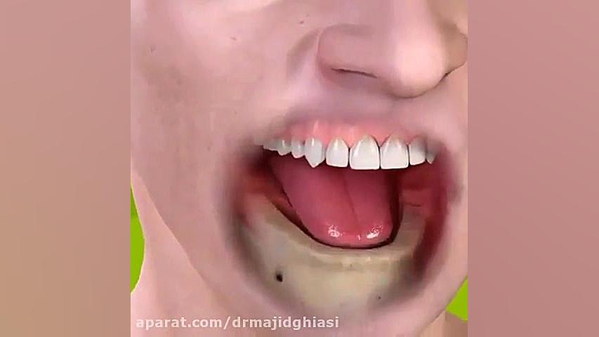 ایمپلنت دندان -دکترمجیدقیاسی دندانپزشک زیبایی درمشهد سیستم ارزیابی هیستوترمیک