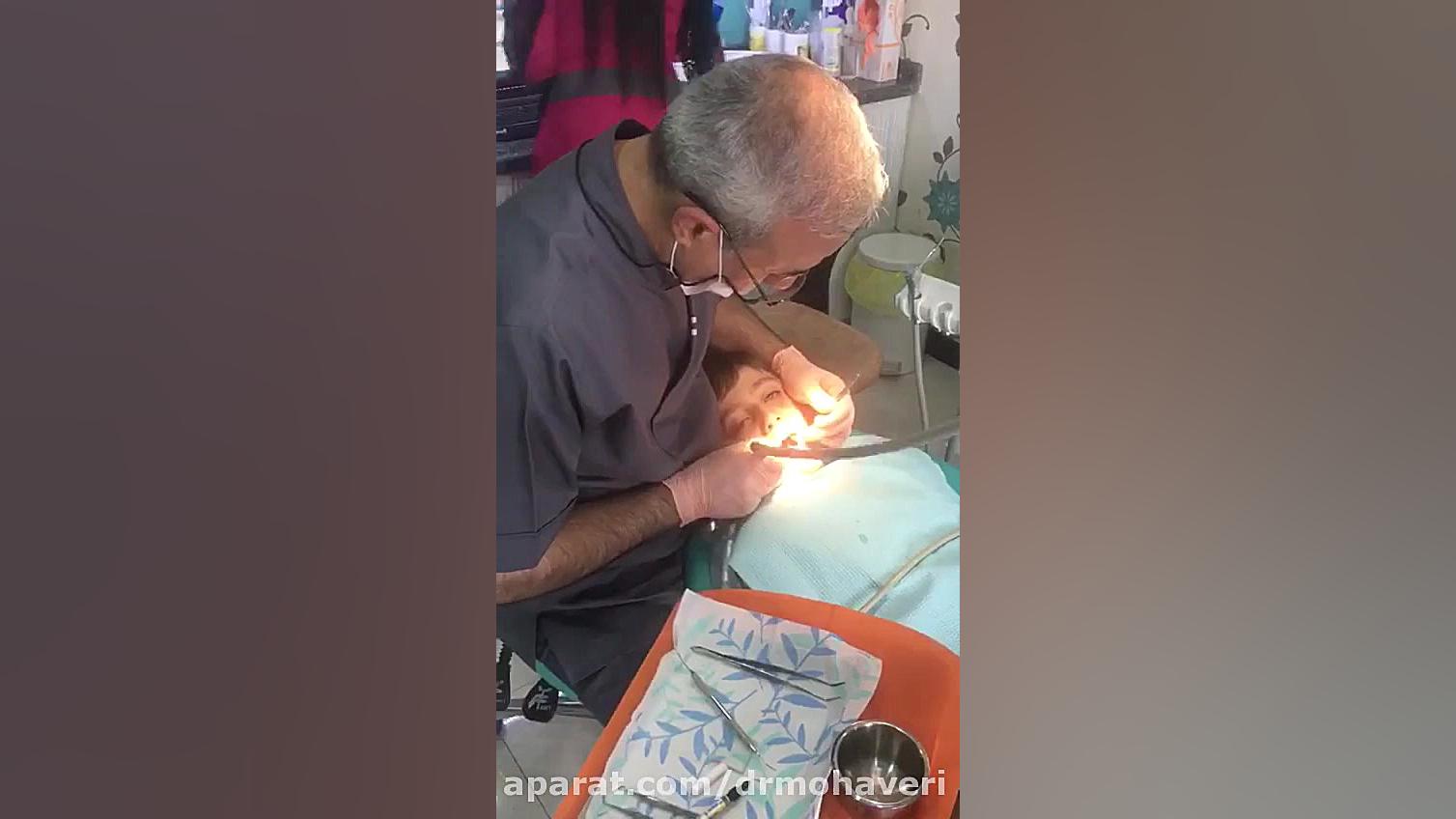 درمان دندانپزشکی کودکان تحت آرامبخشی کربوکسی تراپی
