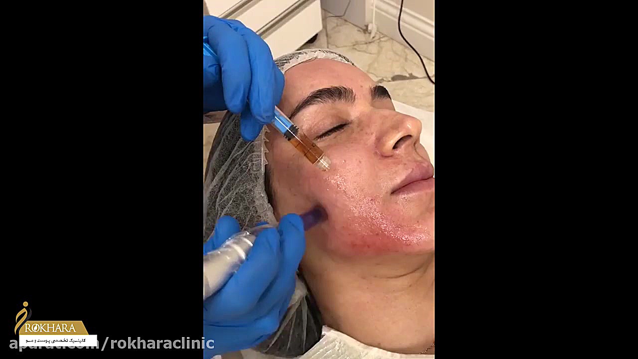 میکرونیدلینگ صورت علامت کرنیگ