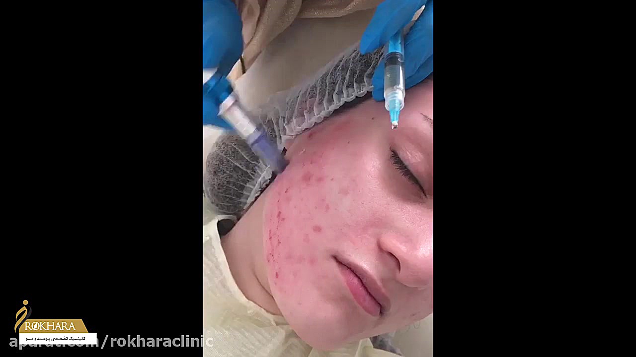 میکرونیدلینگ صورت Förster Resonance Energy Transfer Test