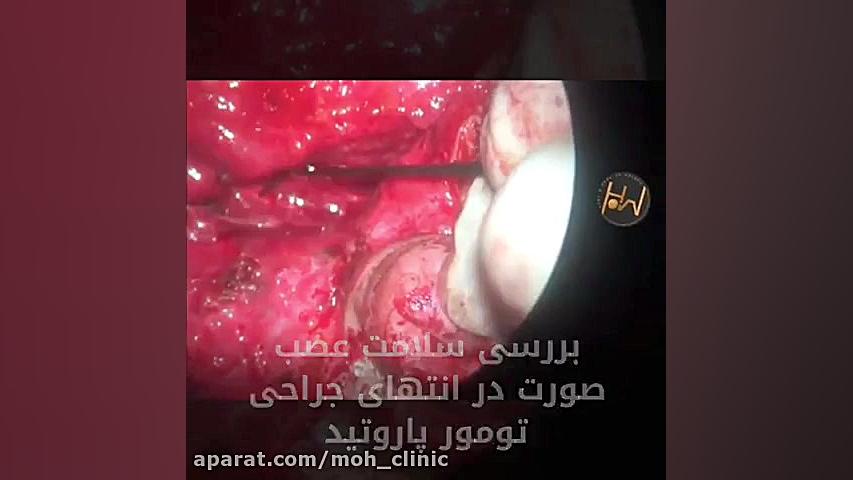 بررسی سلامت عصب صورت در انتهای جراحی تومور پاروتید MRCP