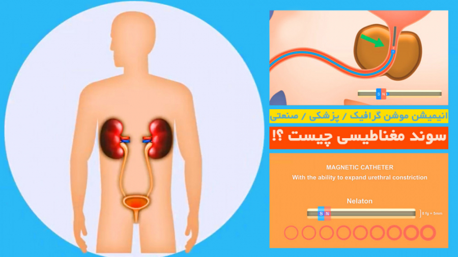 انیمیشن پزشکی / صنعتی - سوند مغناطیسی لیزر فرکشنال