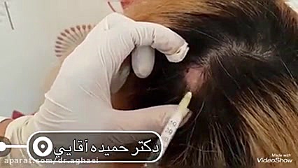 درمان ریزش موی سکه ای با مزوتراپی دکتر حمیده آقایی