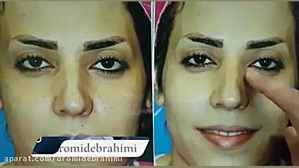 عمل بینی استخوانی توسط دکتر امید ابراهیمی بهترین جراح بینی استخوانی دکتر امید ابراهیمی