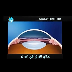 علاج الزرق في ايران - علاج العيون في ايران - طب العيون في ايران - دكتور تجميل علاج الزرق في ايران - عل...